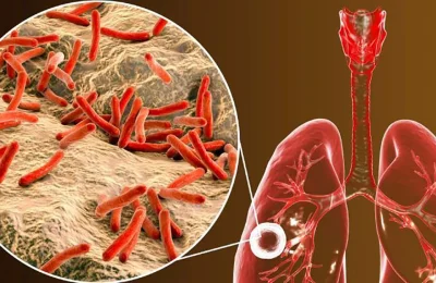 bacilo-tuberculosis.jpg