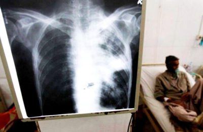 tuberculosis--696x411